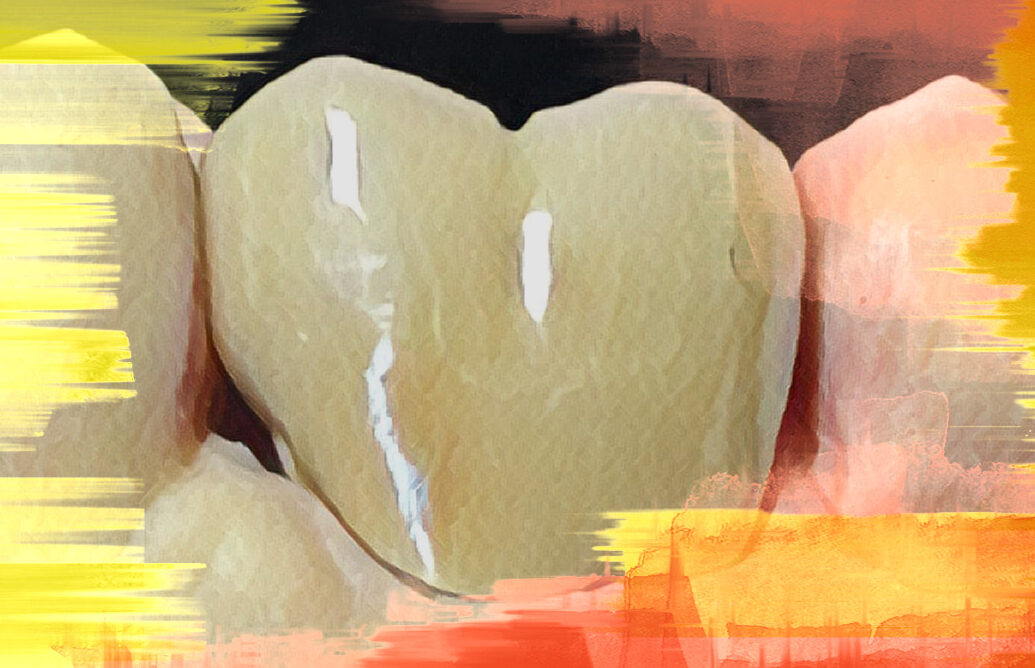 Dental Crown Dental Crown