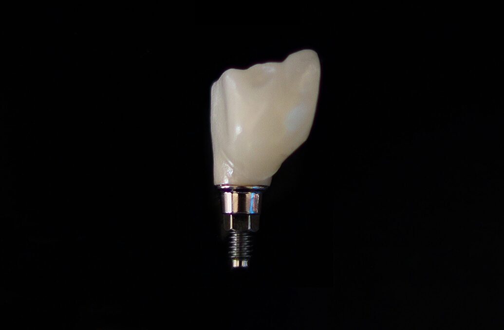 Dental implant